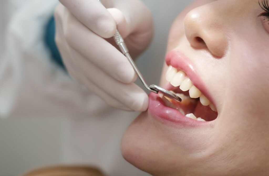A close-up of a patient’s teeth while a dental professional in white gloves uses a mouth mirror during a cleaning.
